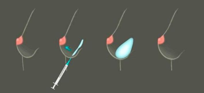 Expansion mammaire à l'aide d'injections à base de hyaluronato