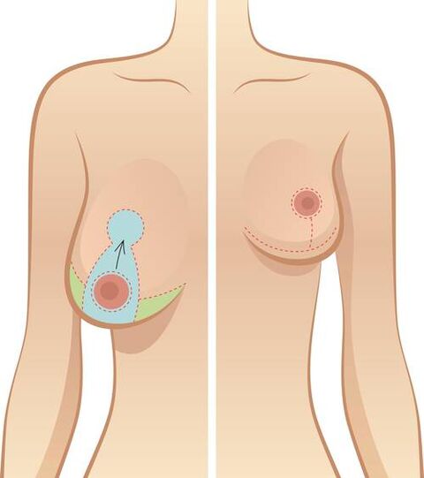 La chute des seins est une indication de l'opération