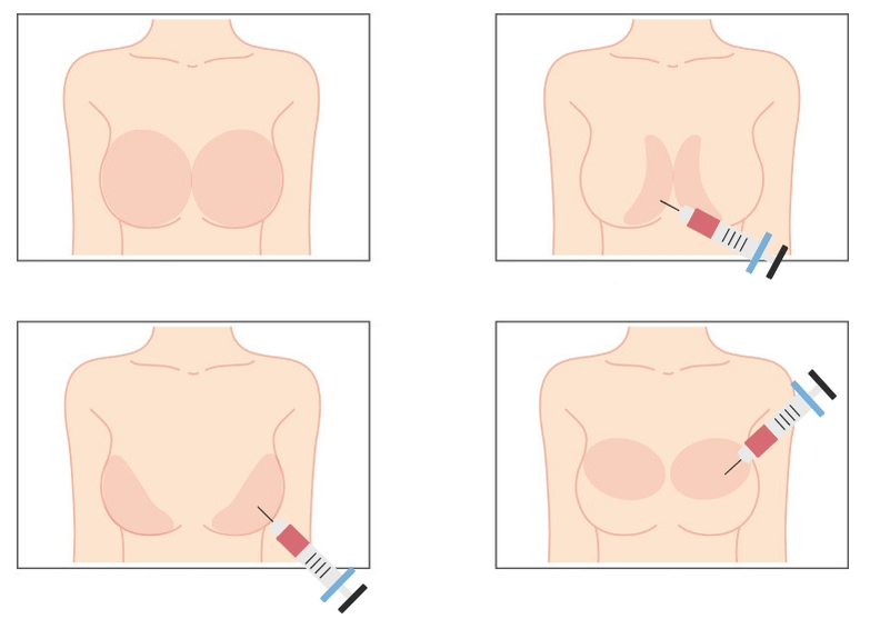 Emplacements d'injection d'acide hyaluronique dans la poitrine.