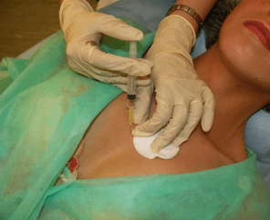 Introduction du méso-cocktail dans le tissu mammaire, une alternative aux injections d'acide hyaluronique