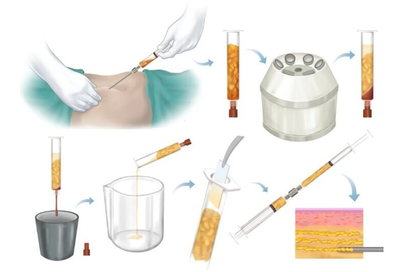 Élimination de la graisse des zones à problèmes, traitement et injection dans le tissu mammaire.