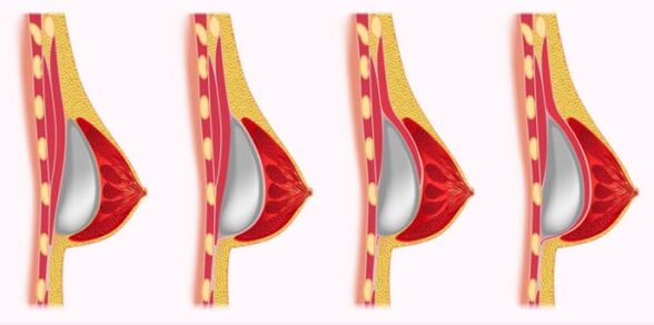 méthodes d'installation d'implants d'augmentation mammaire