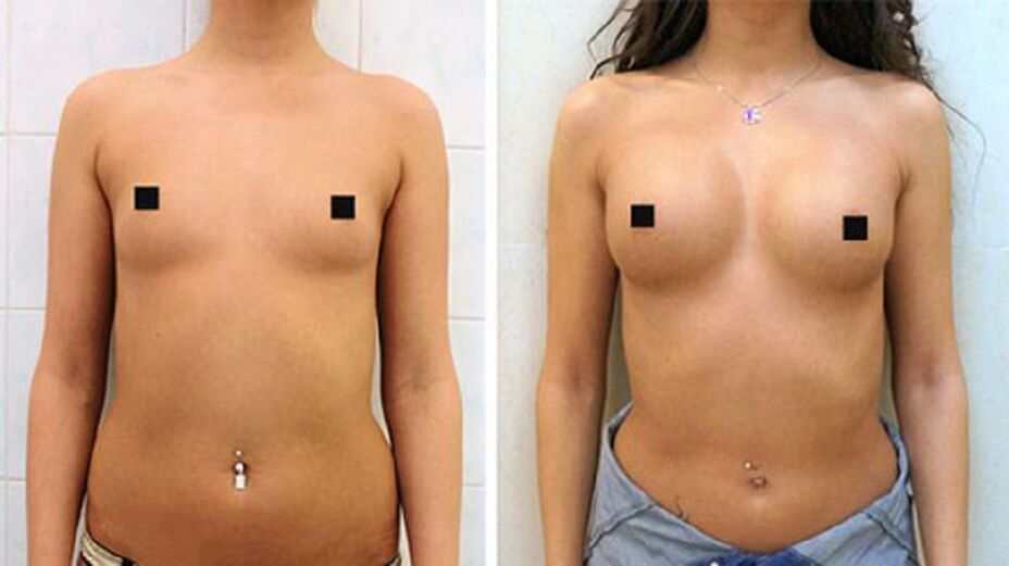 Le résultat d’une augmentation mammaire avec des injections d’hyaluronate.