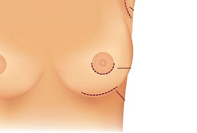 méthodes d'accès chirurgical pour l'augmentation mammaire