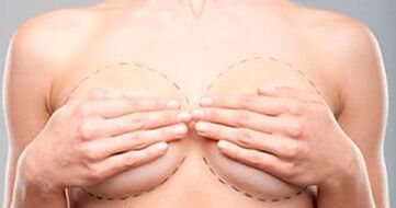 Marquage mammaire avant lifting et augmentation. 